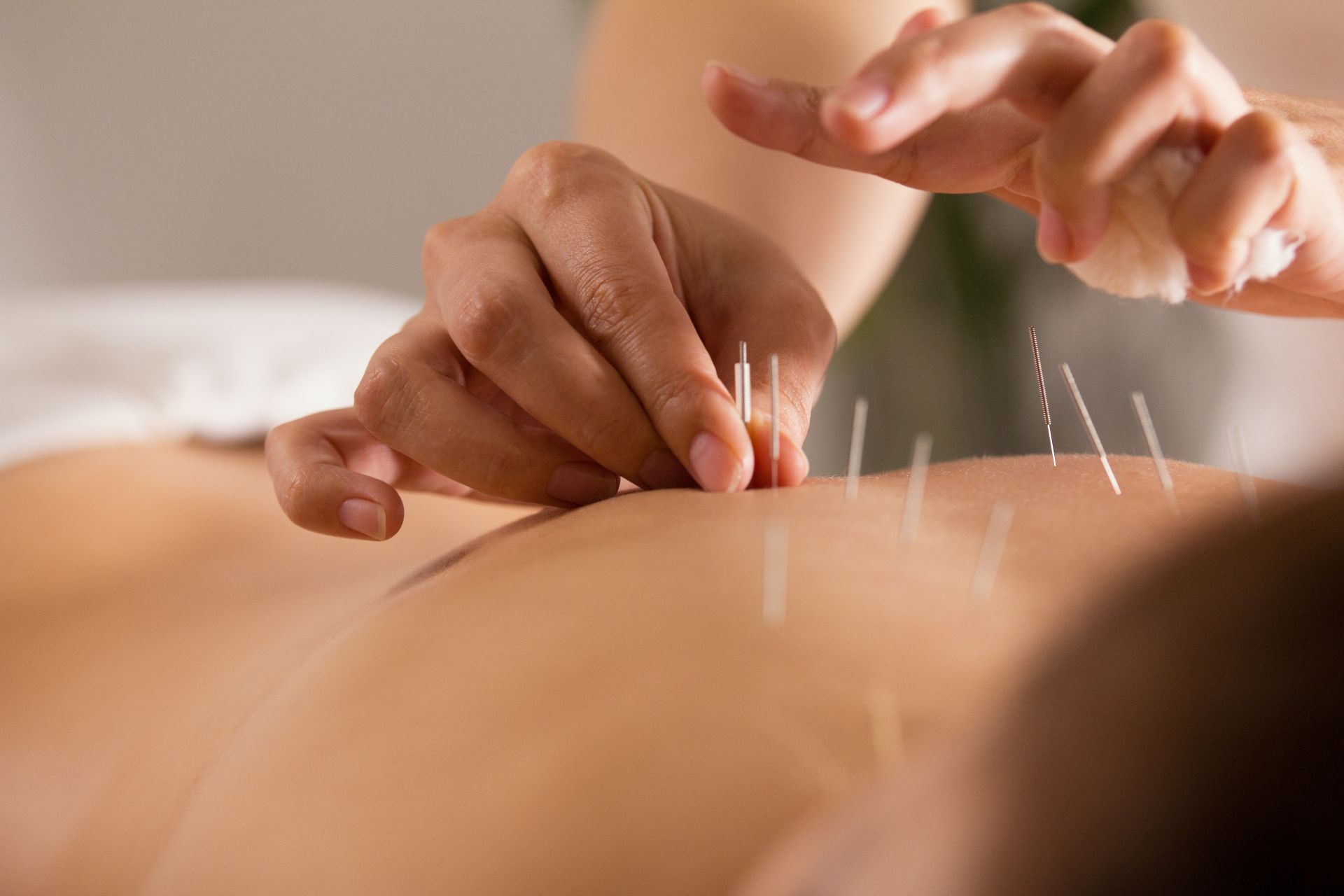 Close up of an acupuncturist is carefully placing acupuncture needles on the back of a client.